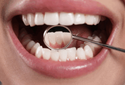 A close-up of a person's mouth and dental mirror tool examining the back bottom teeth, representing oral health and cancer