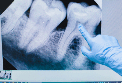 A hand pointing at x-ray of teeth, representing stages of tooth decay