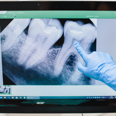A hand pointing at x-ray of teeth, representing stages of tooth decay